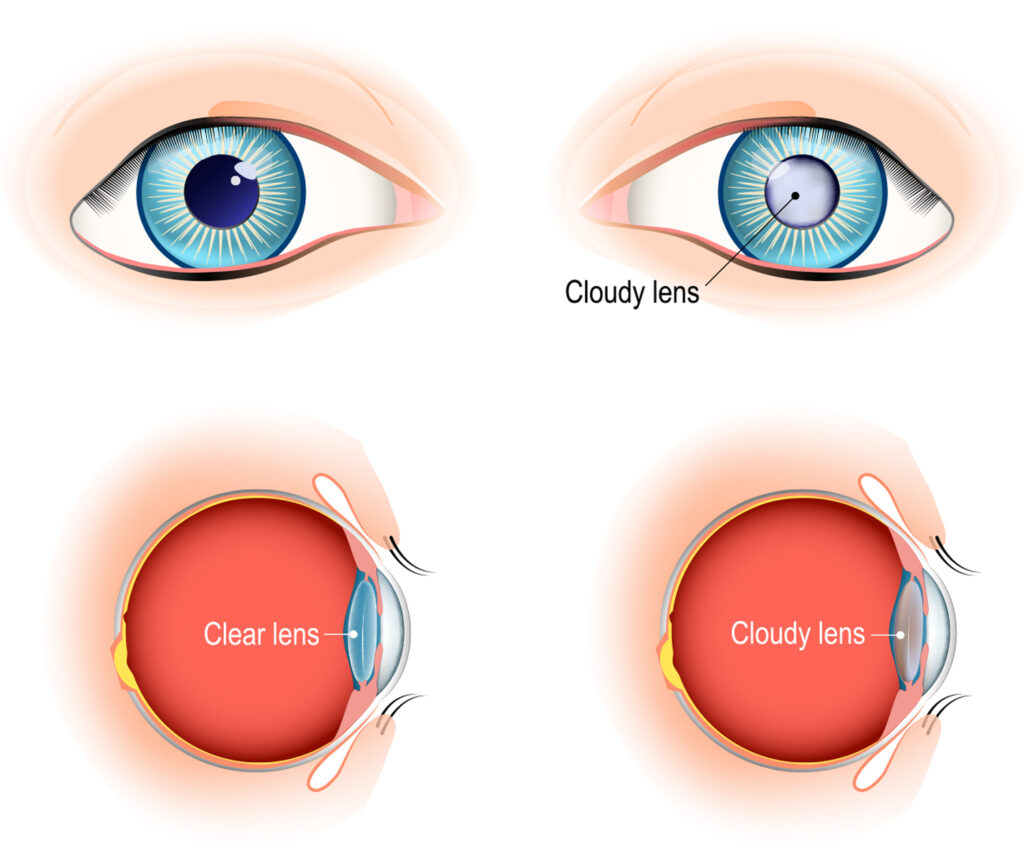 What is a cataract